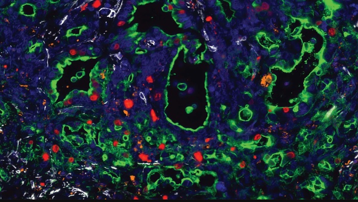 Cáncer de páncreas