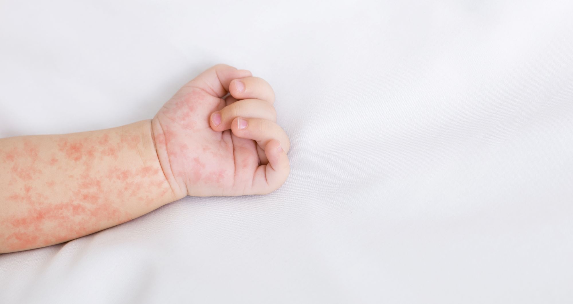 measles rash
