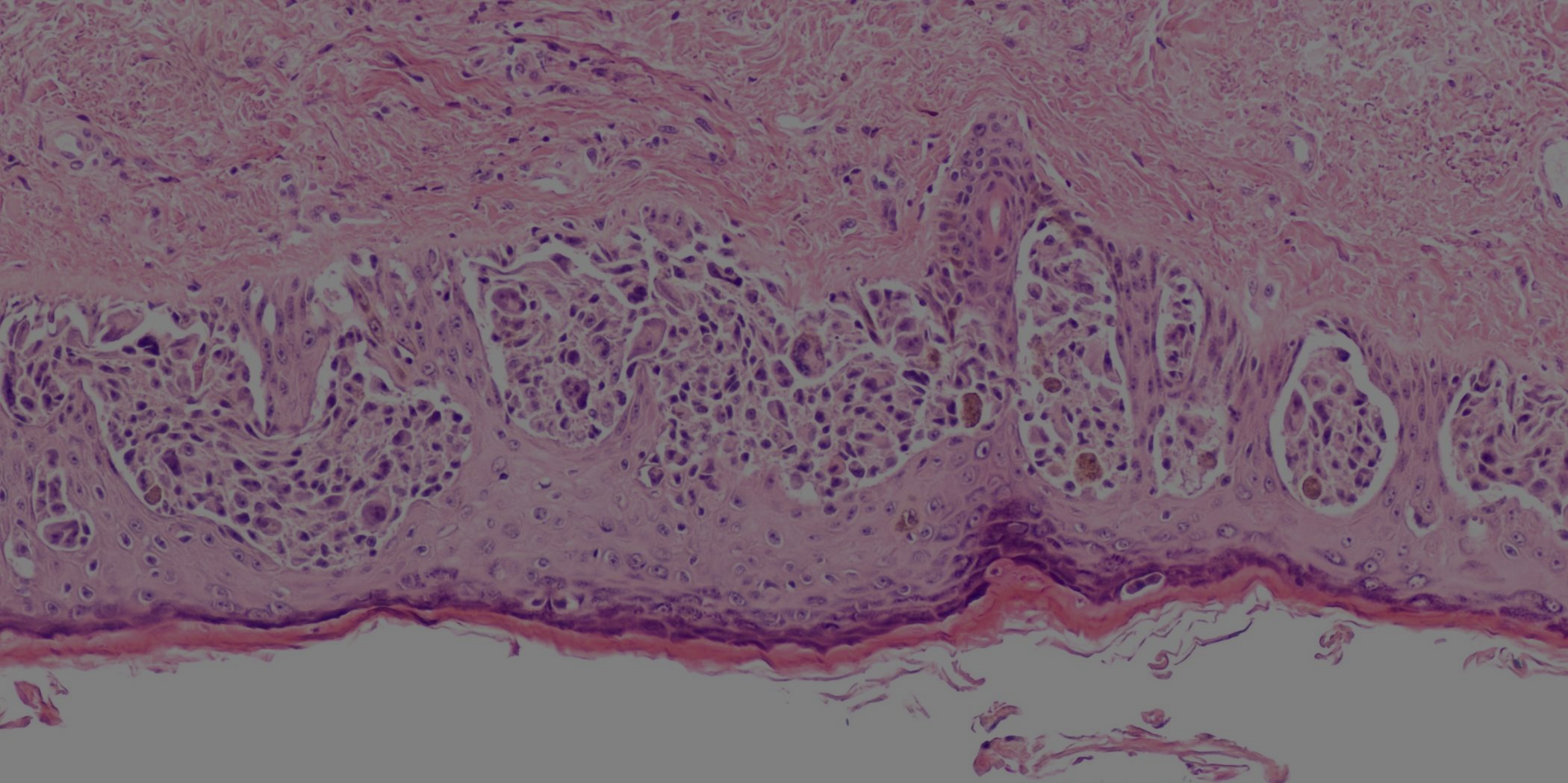 melanoma
