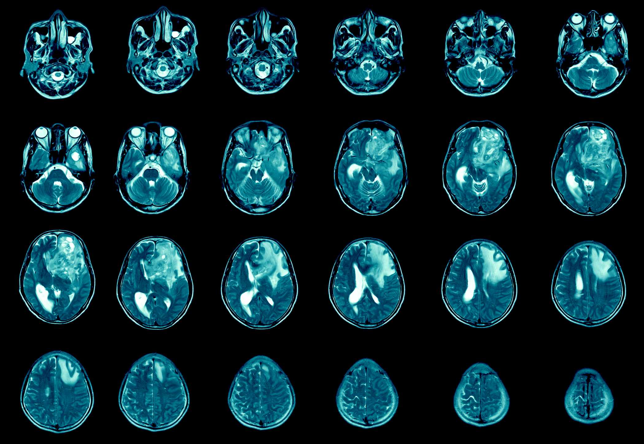 Brain