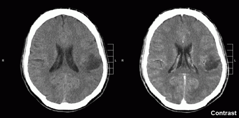 glioma