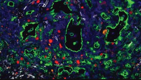 Cáncer de páncreas