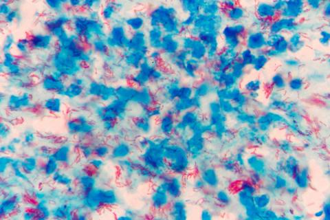 tuberculosis