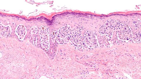 melanoma