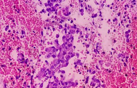 endometrial cancer