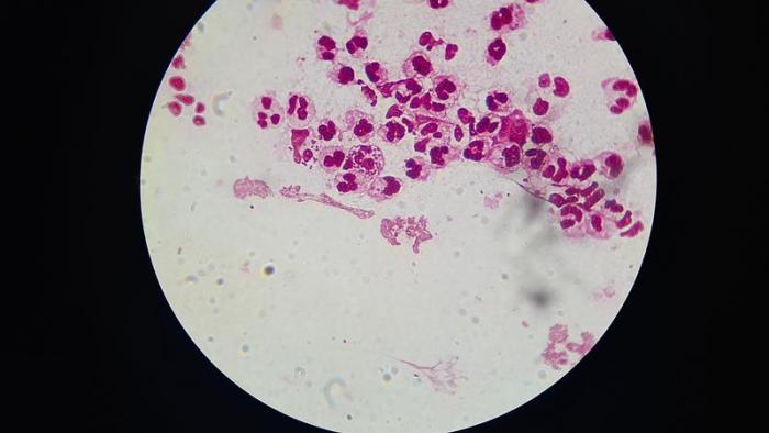 Un ensayo en fase 3 muestra la eficacia de un nuevo antibiótico contra la gonorrea bacterias