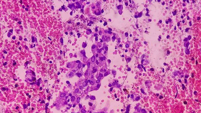 Un nuevo fármaco se muestra eficaz frente al cáncer de endometrio avanzado, según un ensayo de fase 3 cáncer de endometrio
